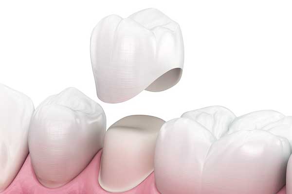 Dental crowns in Turkey