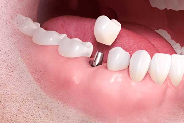 Dental implants in Turkey