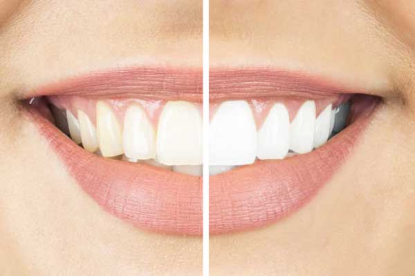 Teeth whitening in Turkey