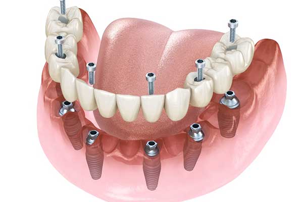 all-on-6 dental implants turkey price: Quality and Affordability