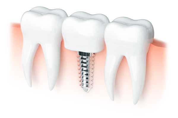 best dental implants in turkey