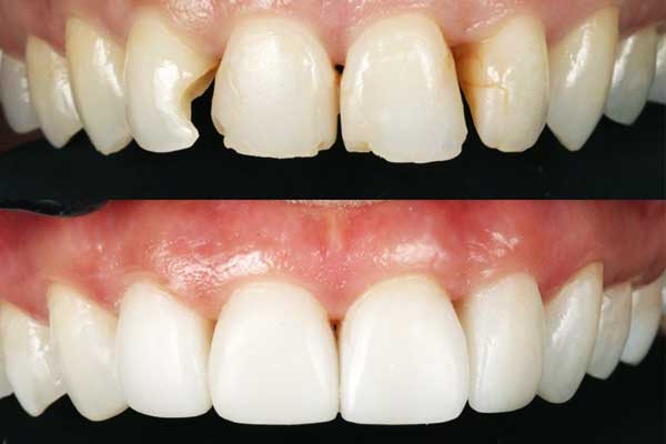 Transform Your Smile with composite bonding istanbul price, Benefits, and FAQs