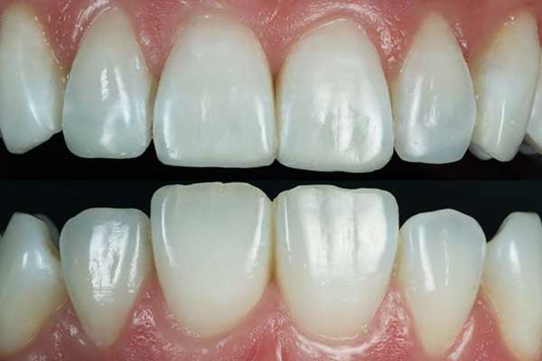 Perfect Your Smile: Composite Bonding Istanbul – Costs, Benefits, and FAQs