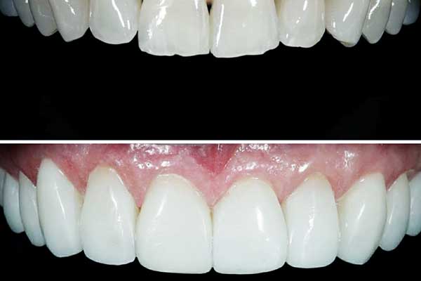 composite veneers turkey price