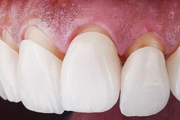 cost of veneers in turkey