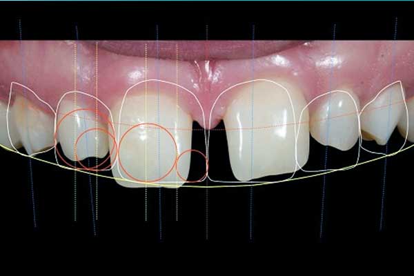 Redefine Your Smile: Dental Design Turkey