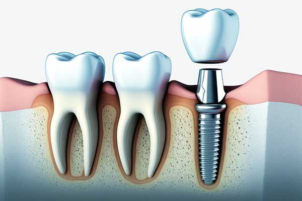 endosteal implants in turkey