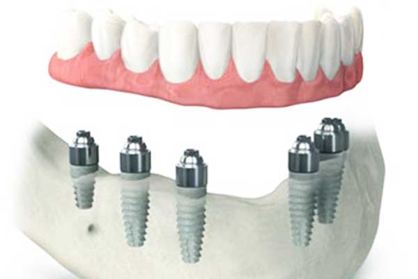 full mouth dental implants turkey package deals reviews