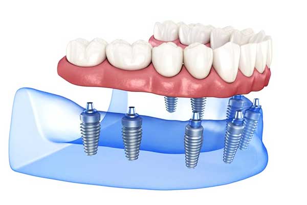 Transform Your Smile: full mouth dental implants turkey price list, Benefits, and FAQs