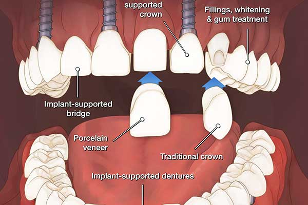 Transform Your Smile: Comprehensive Guide to Full Mouth Restoration Turkey