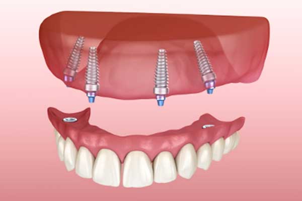 The Ultimate Guide to Getting Your Teeth Done in Turkey