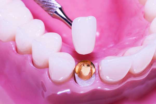 gold dental crowns in turkey