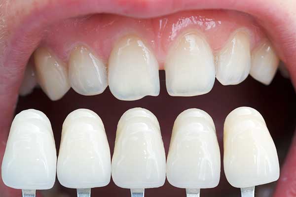 Achieve a Perfect Smile: how much are porcelain veneers turkey?