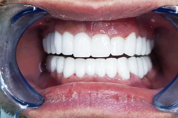 Achieve a Perfect Smile: How Much Does It Cost to Get Veneers in Turkey?