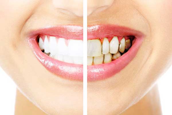 Transform Your Smile: How to Get Your Teeth Done in Turkey – A Comprehensive Guide