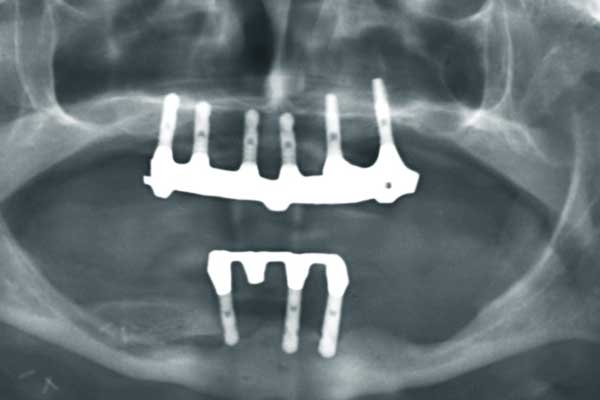 Instant Transformation: Immediate Load Implants Turkey – Costs, Benefits, and FAQs