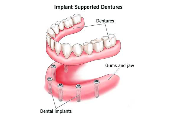 Secure Your Smile: Implant Retained Dentures Turkey – Costs, Benefits, and FAQs