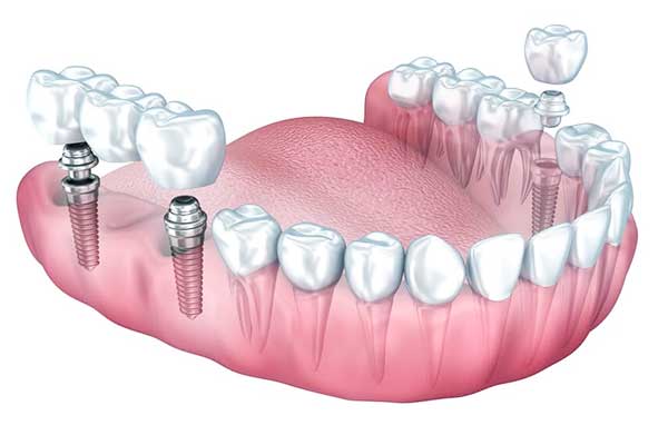 implant-supported bridge in turkey