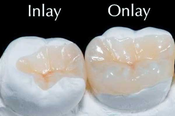 inlay dental in turkey