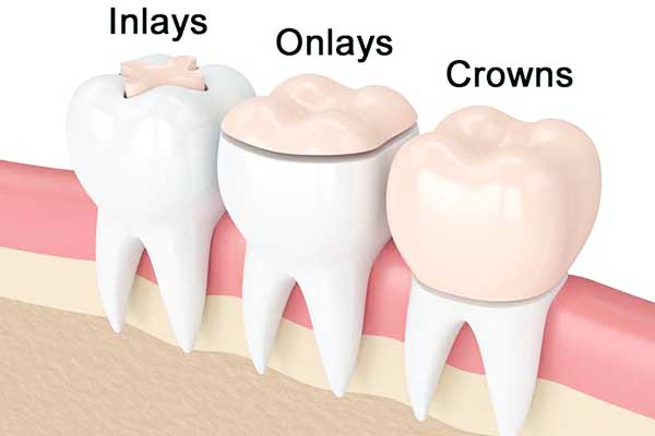 inlays and onlays restorations in turkey