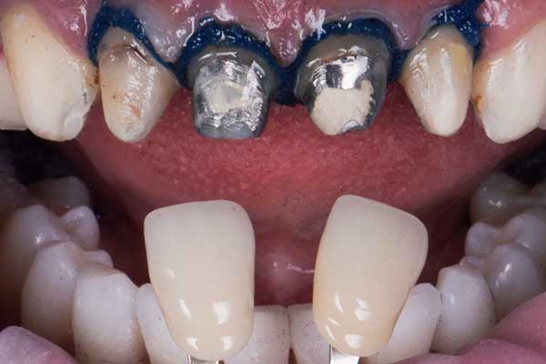 Is It Safe to Get Your Teeth Done in Turkey? A Comprehensive Guide