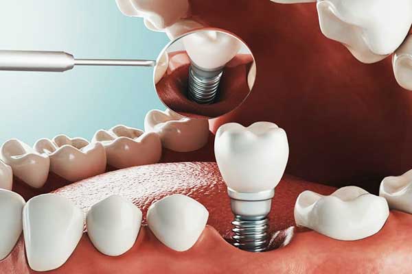 istanbul dental implants price, Benefits, and FAQs