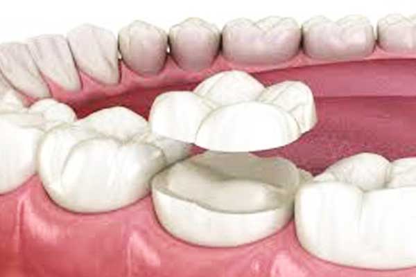 Enhance Your Smile with onlays dental in turkey