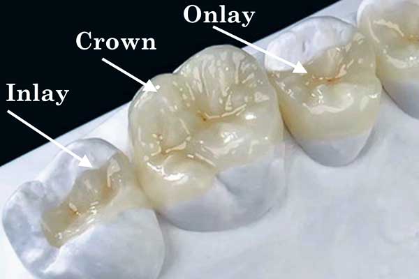 Elevate Your Dental Health: Porcelain Inlays and Onlays Turkey