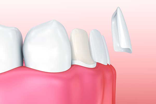 Achieve a Radiant Smile with Porcelain Veneers in Turkey