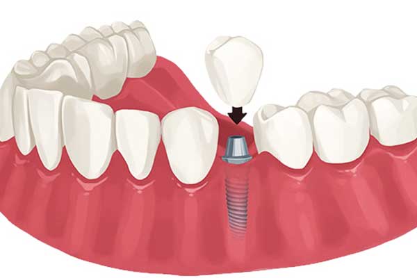 same day dental implants in turkey