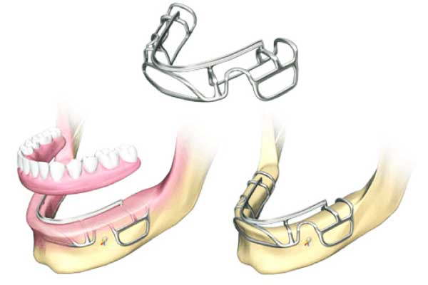 subperiosteal implants in turkey