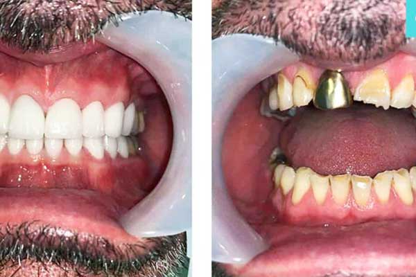 Transform Your Smile: Getting Your Teeth Done  Turkey