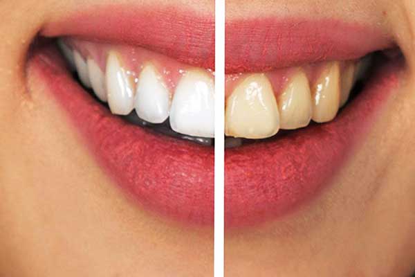 teeth whitening turkey istanbul prices