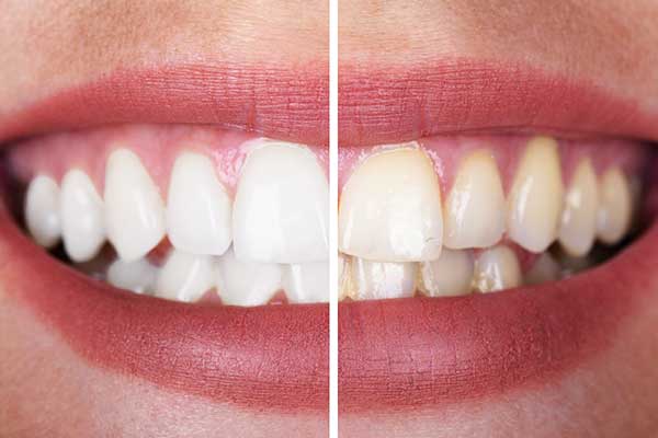 Brighten Your Smile: Teeth Whitening Turkey Prices, Benefits, and FAQs