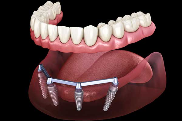 Affordable Excellence: Understanding turkey dental cost