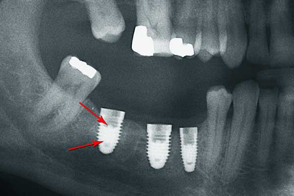 When Dental Dreams Turn into Nightmares: Turkey Teeth Implants Gone Wrong – What You Need to Know