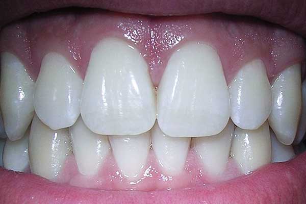 Unlock Your Perfect Smile: Turkey Teeth Price Guide and FAQs