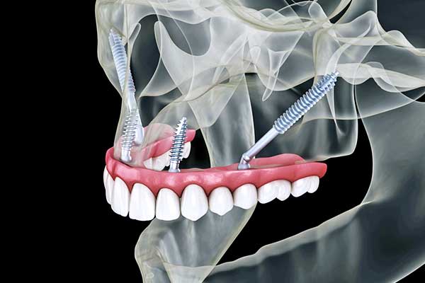 zygomatic implant treatment in turkey