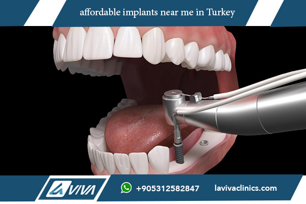 Discover the Top 10 Benefits of Affordable Implants Near Me: Positive Feelings Guaranteed