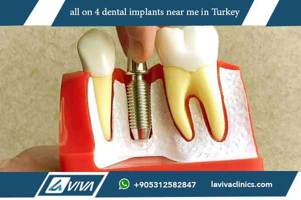 all on 4 dental implants near me A Comprehensive Guide