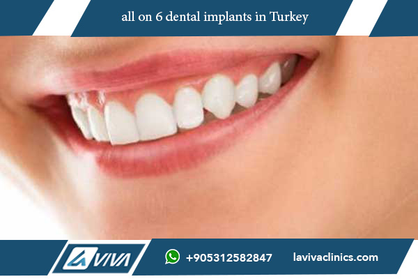 all on 6 dental implants