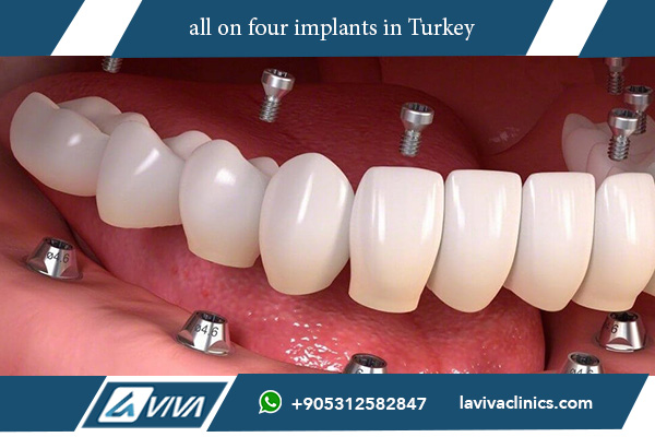 The Positive Impact of All on Four Implants: A Comprehensive Guide