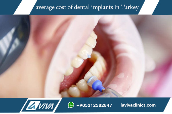 average cost of dental implants