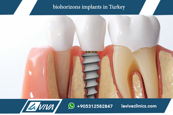 BioHorizons Implants: 10 Positive Steps to Your Perfect Smile