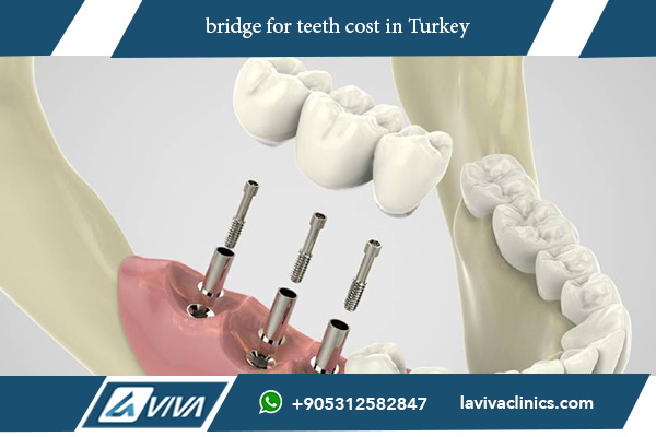 bridge for teeth cost