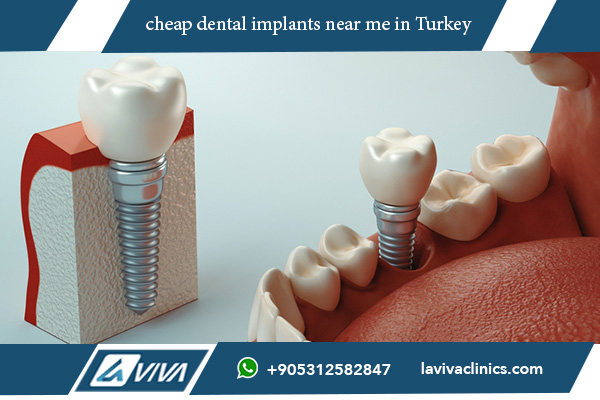 Cheap Dental Implants Near Me: Discover the Best Options and Save Money