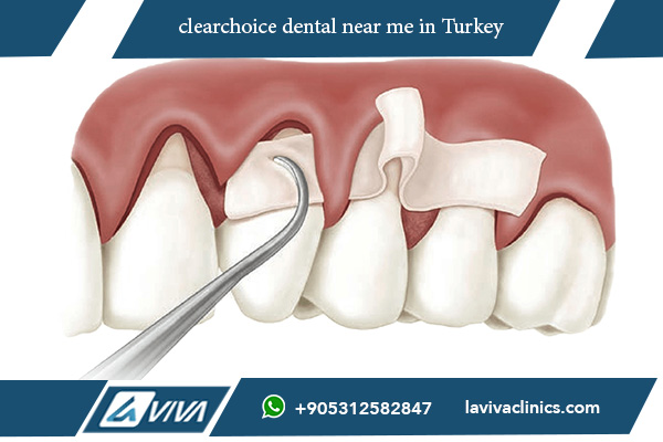 Discover the Top 10 Benefits of ClearChoice Dental Near Me: Your Guide to Positive Outcomes