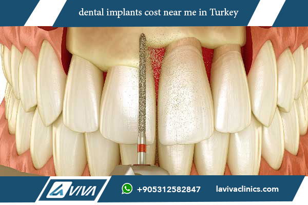 dental implants cost near me