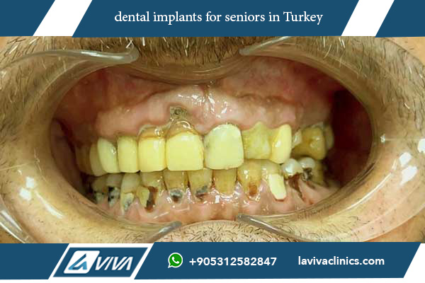 dental implants for seniors