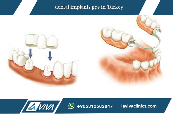 Everything You Need to Know About dental implants gps: 10 Key Insights to Ensure Positive Results